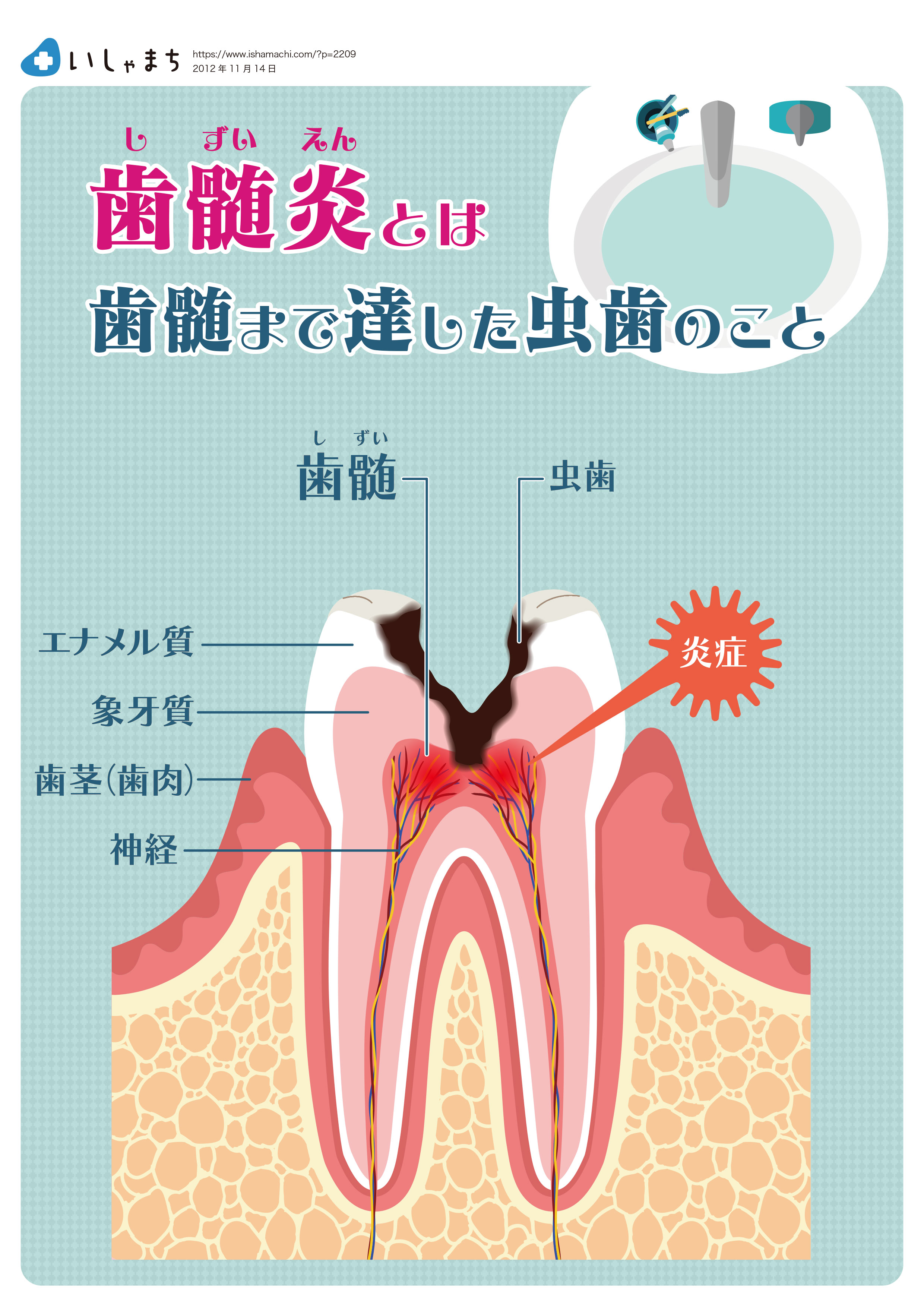 歯髄炎とは-図解