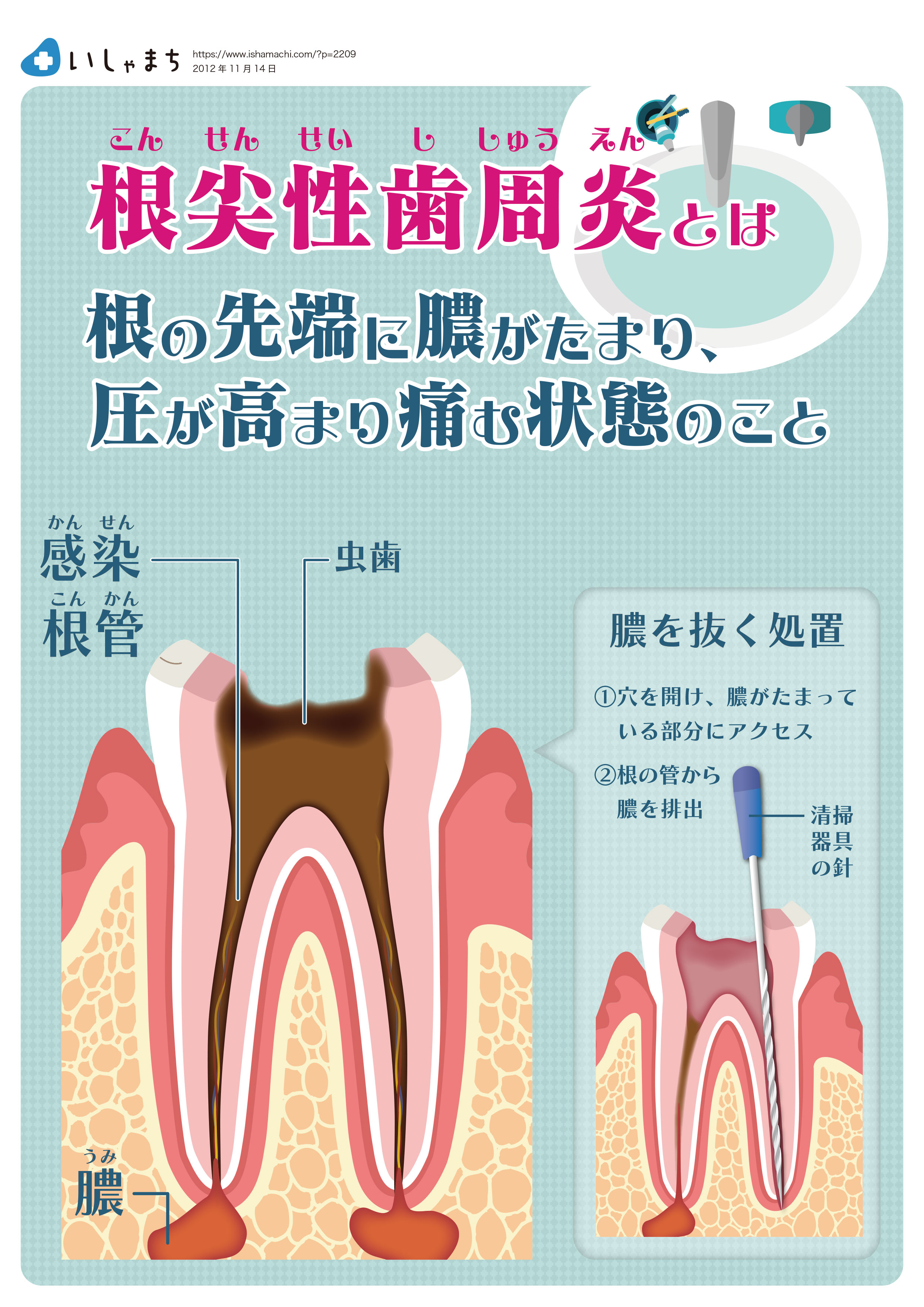 根尖性歯周炎とは-図解