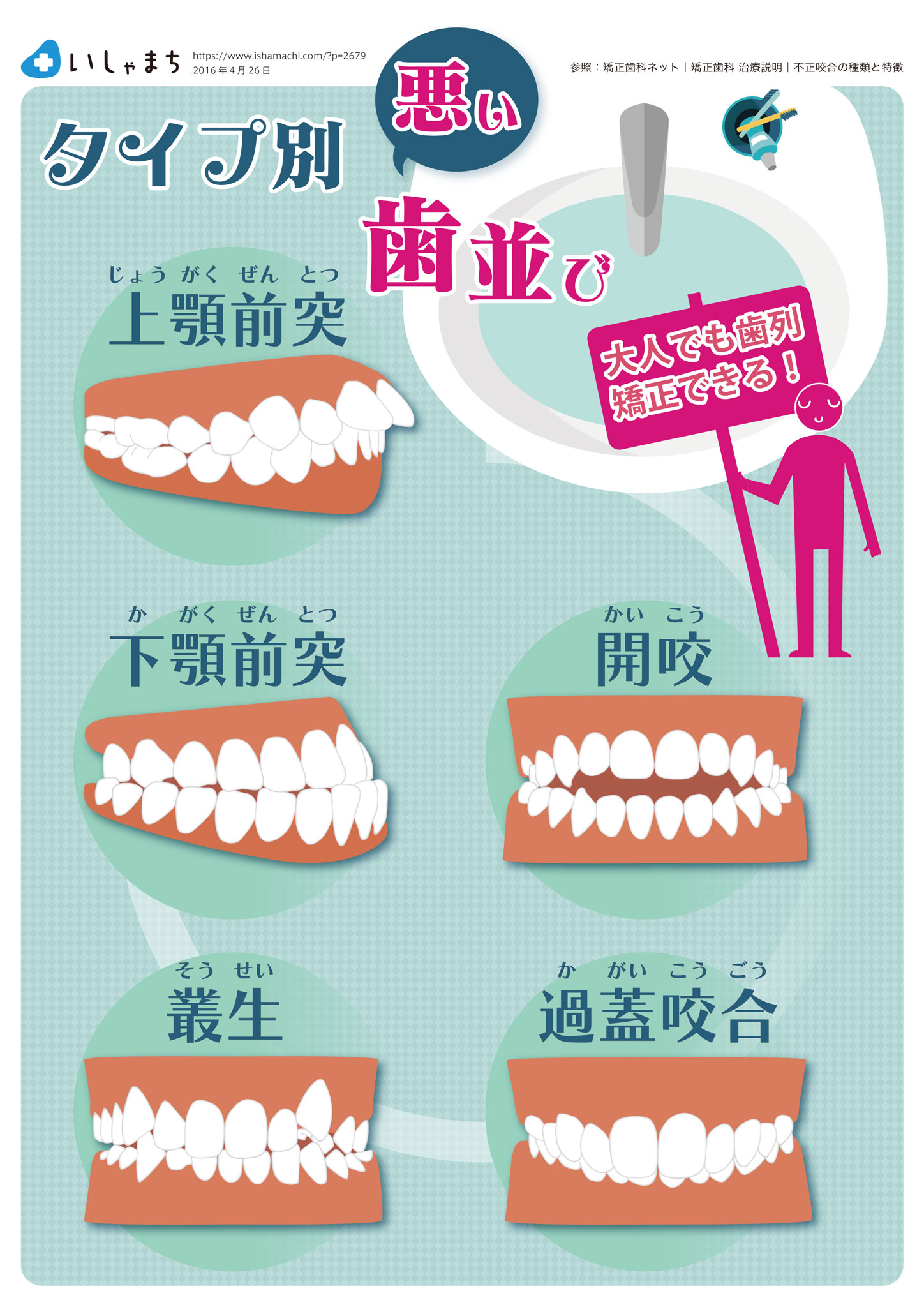 タイプ別・悪い歯並びとそのデメリット-図解