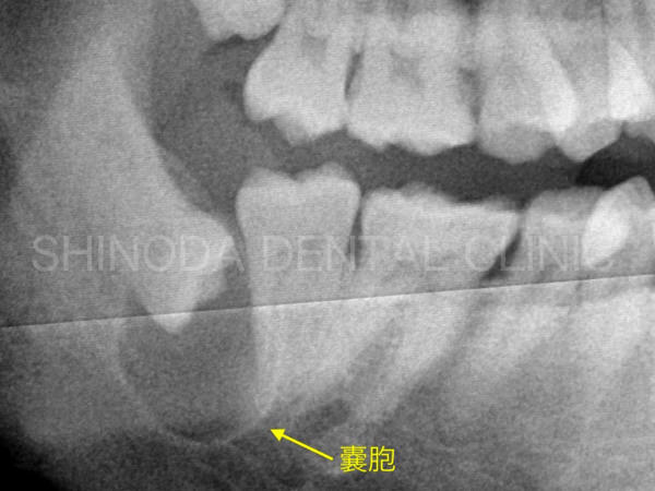 歯科レントゲン写真