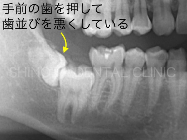 歯科レントゲン写真