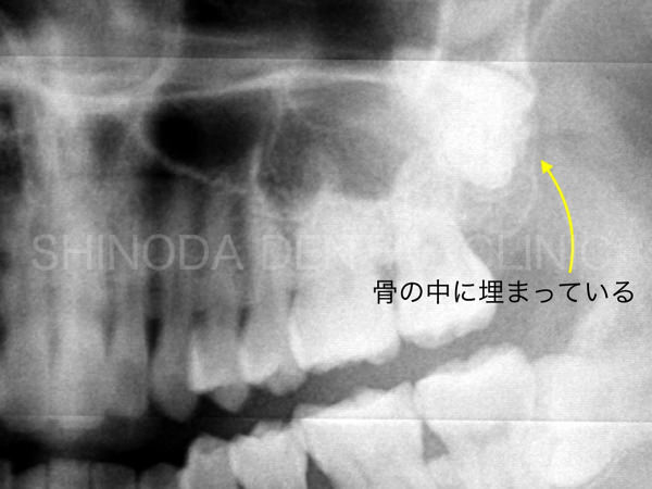 歯科レントゲン写真