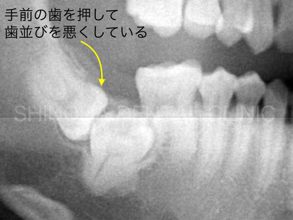 歯科レントゲン写真