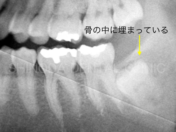 歯科レントゲン写真