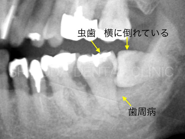 レントゲン写真