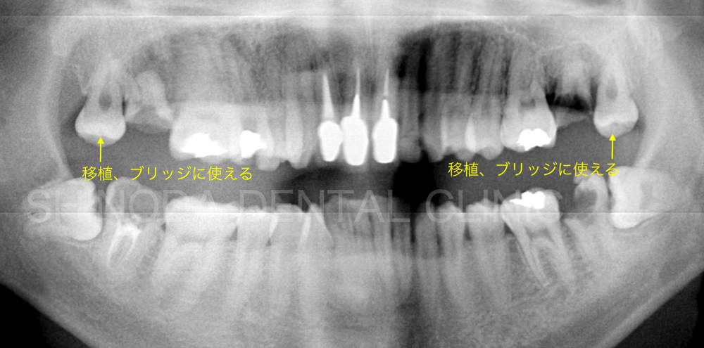 歯科レントゲン写真