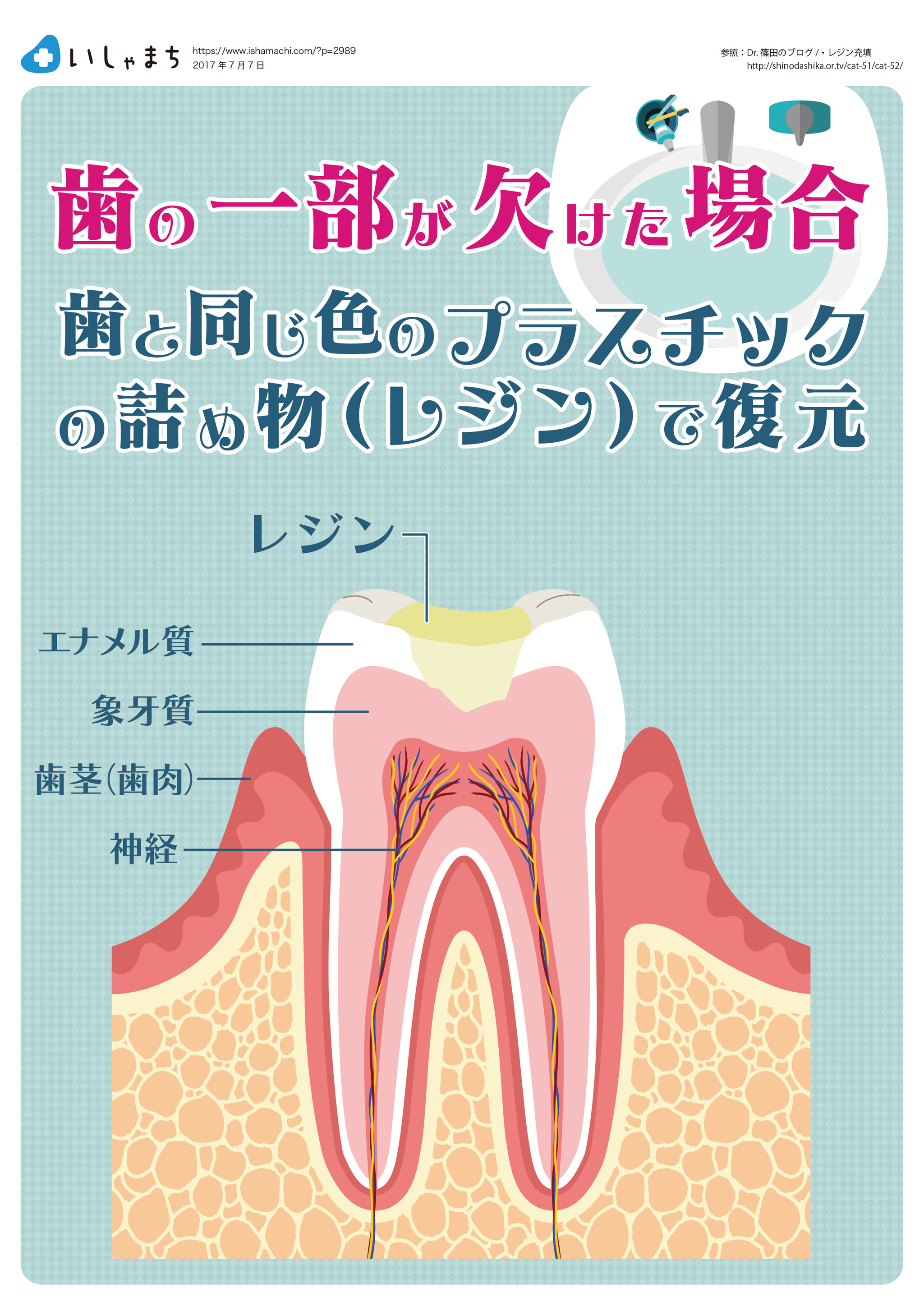 歯の一部が欠けてしまった場合-図解