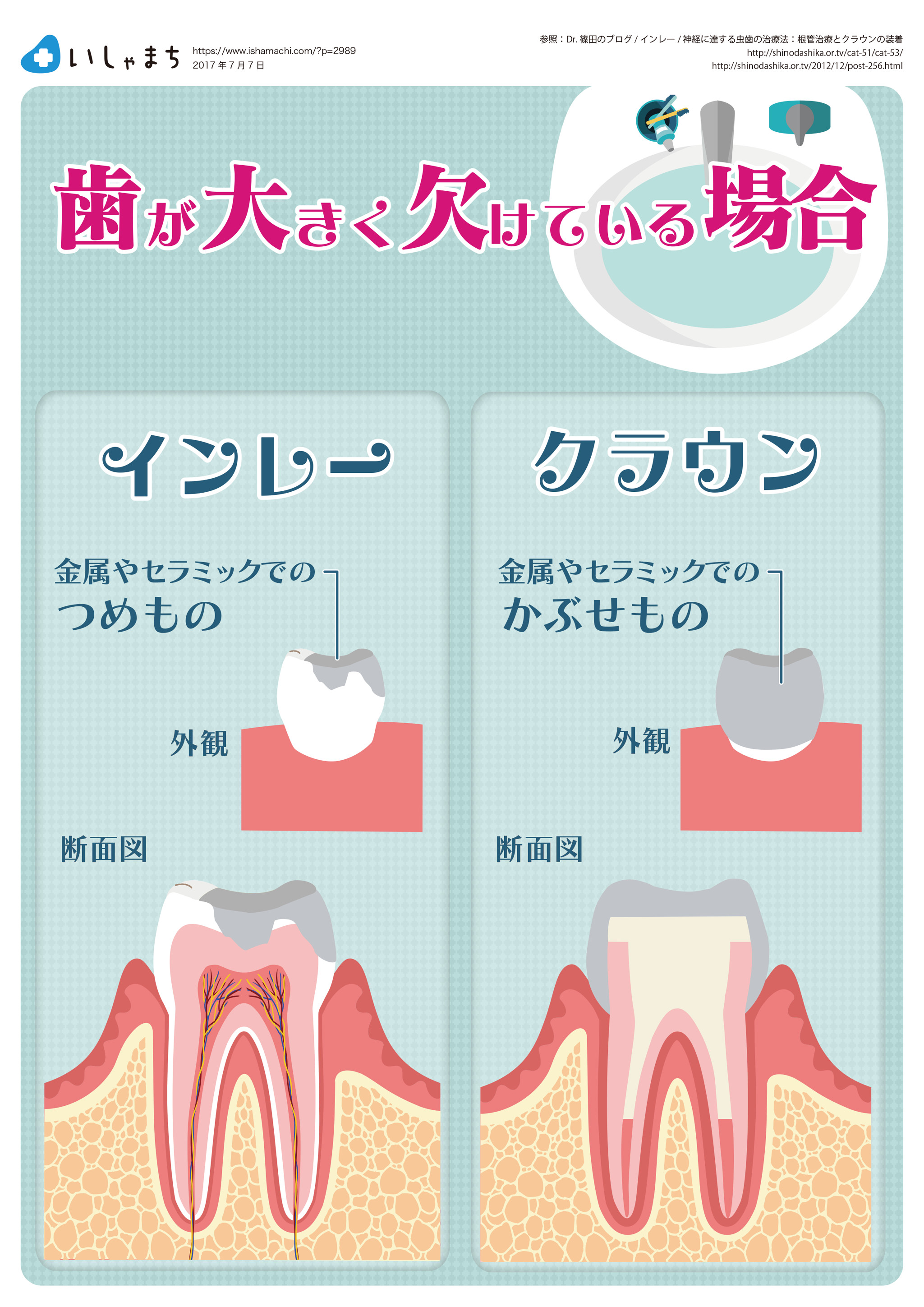 歯が大きく欠けている場合ー図解