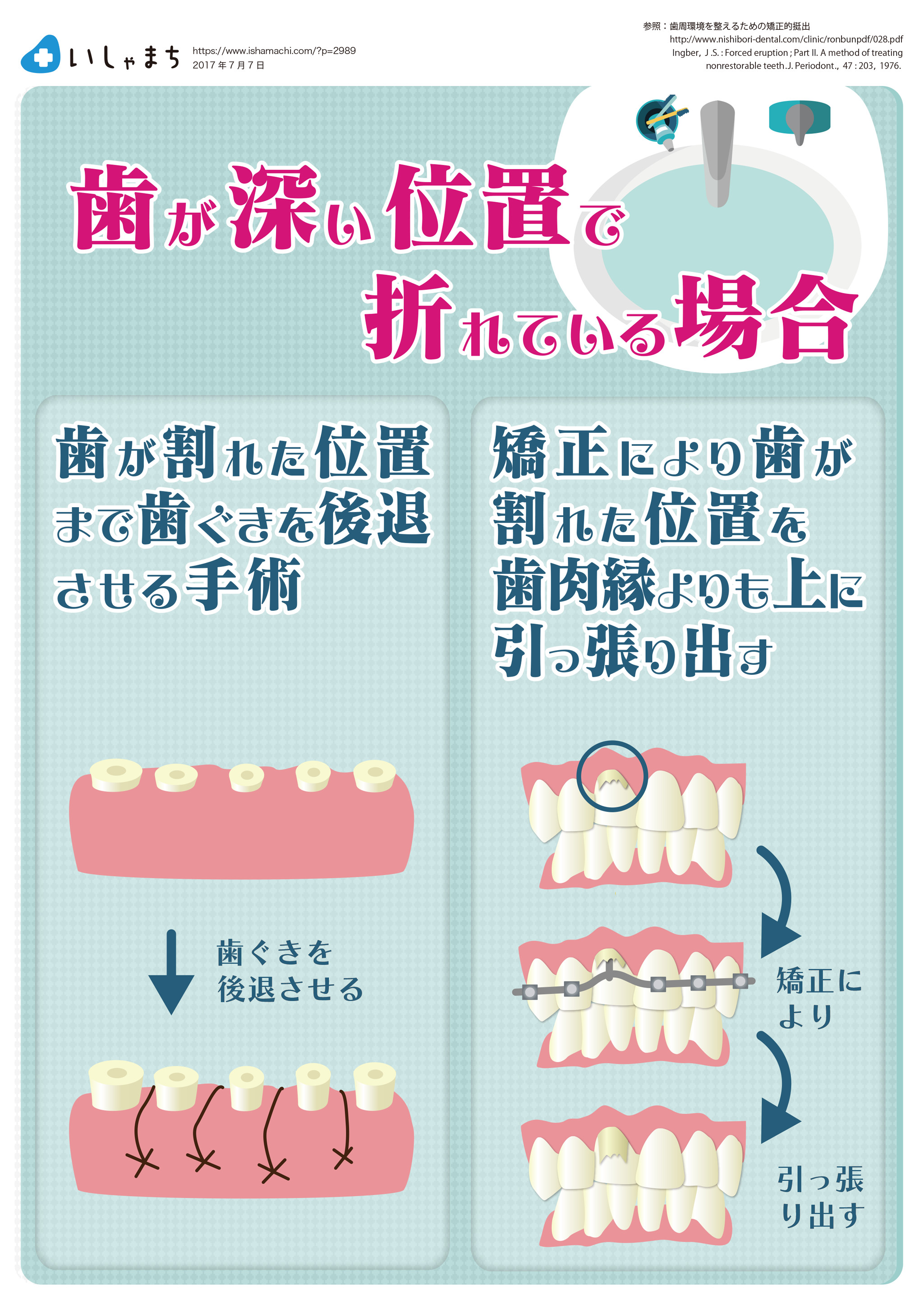 歯が深い位置で折れている場合-図解