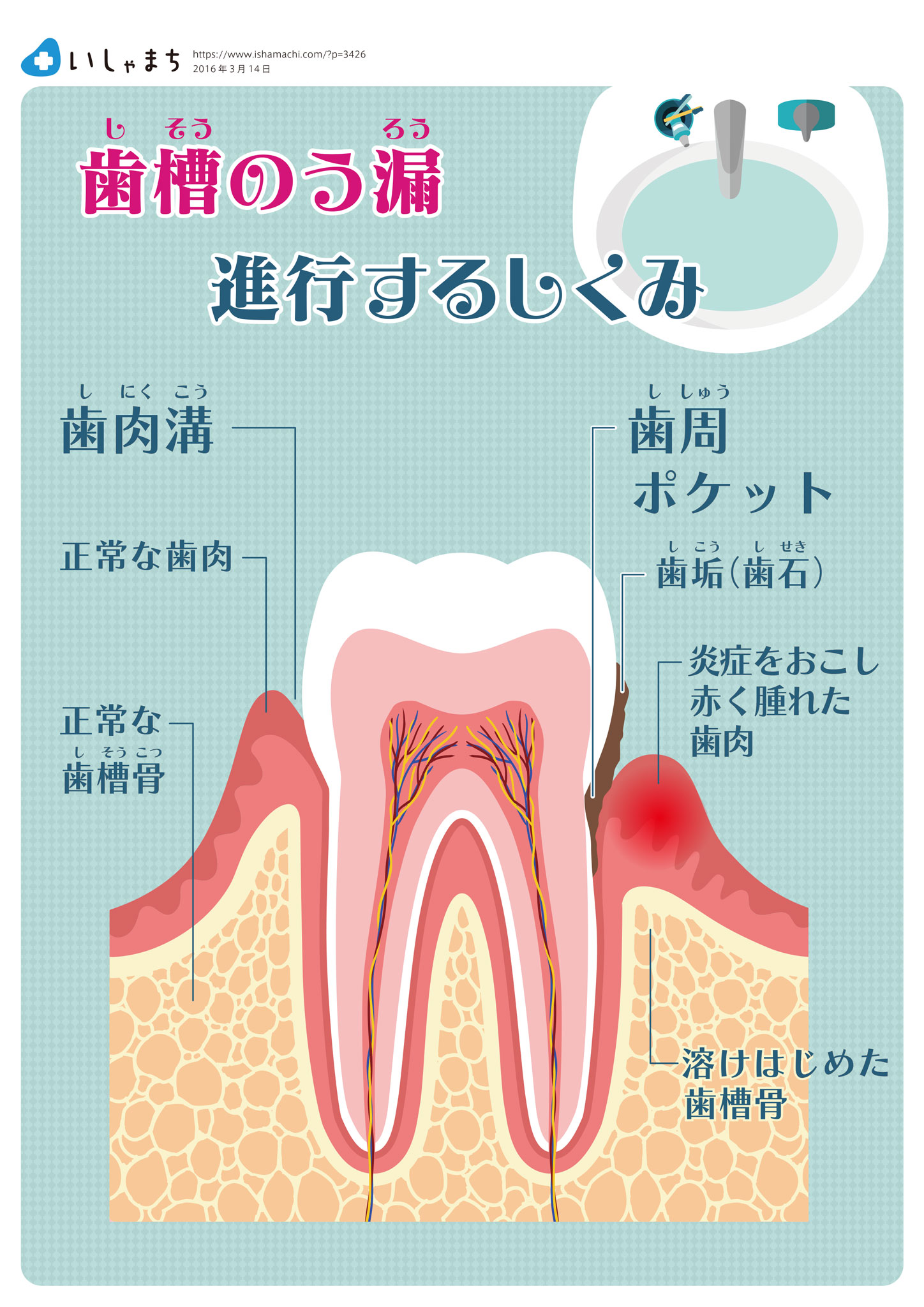 歯槽のう漏のしくみ-図解