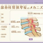 腰部脊柱管狭窄症のメカニズム
