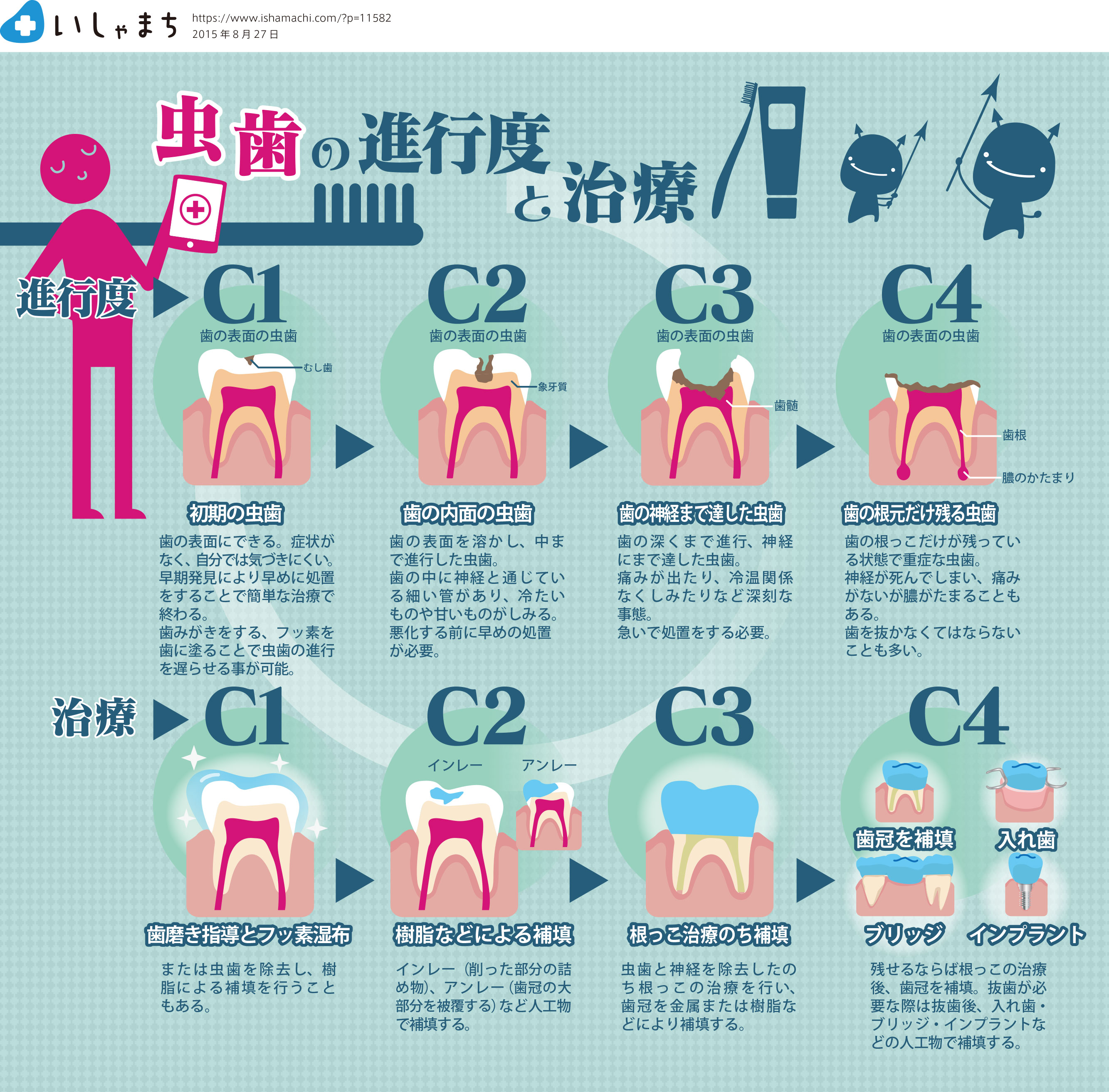 虫歯の進行度と治療-図解