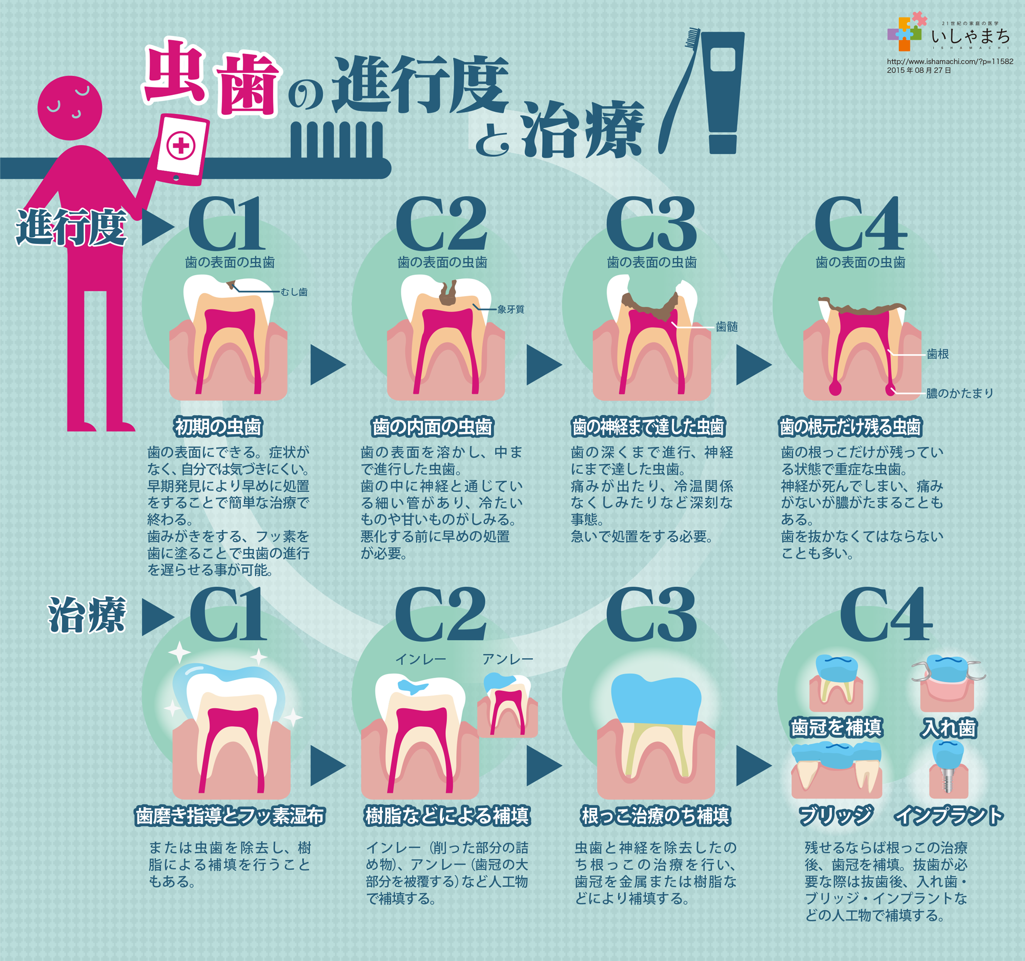 虫歯の進行度と治療