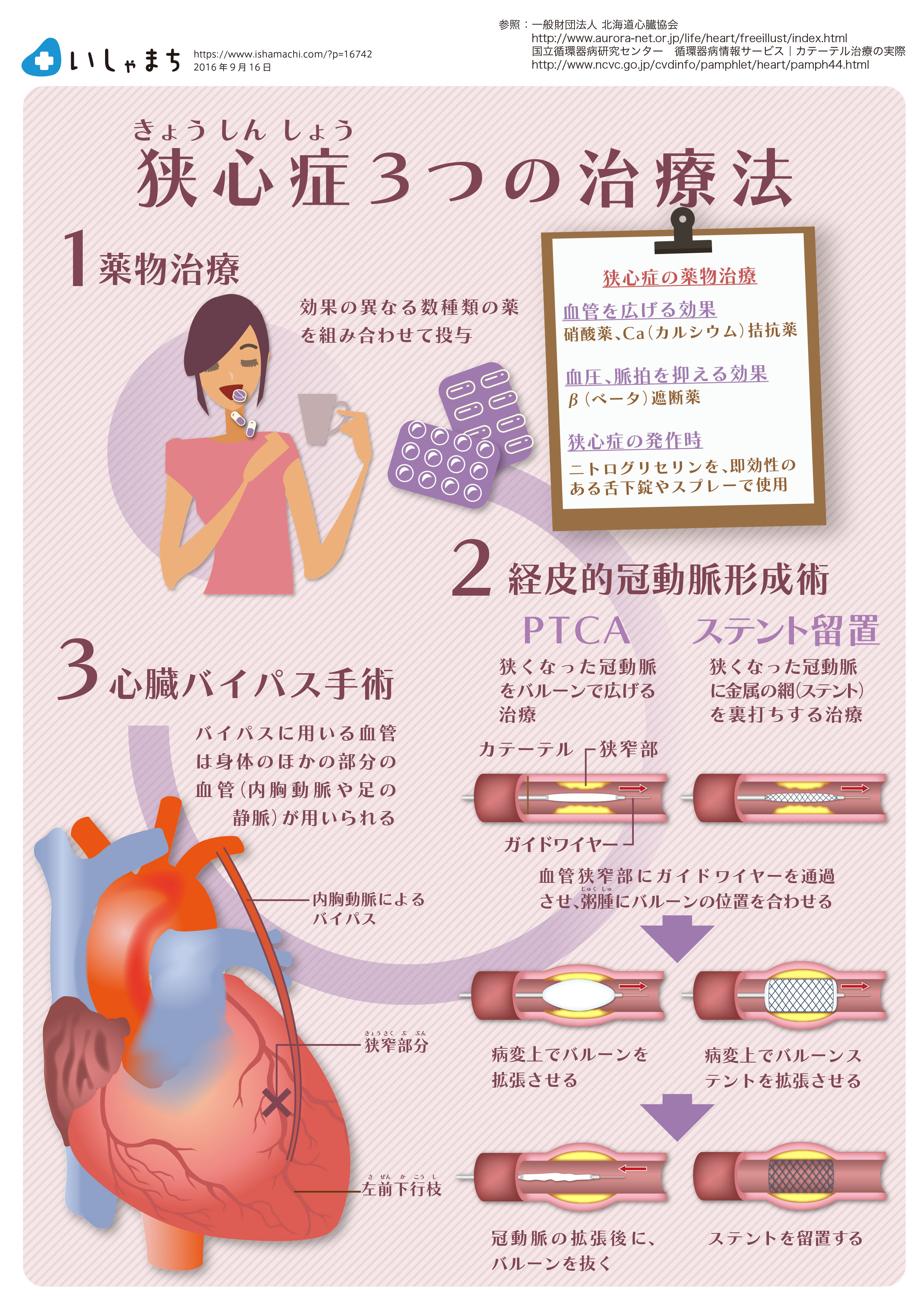 狭心症の３つの治療法-図解