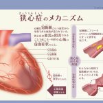 狭心症のメカニズム