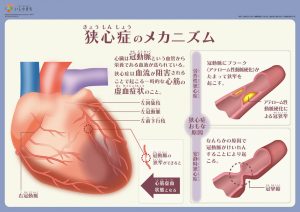 狭心症のメカニズム