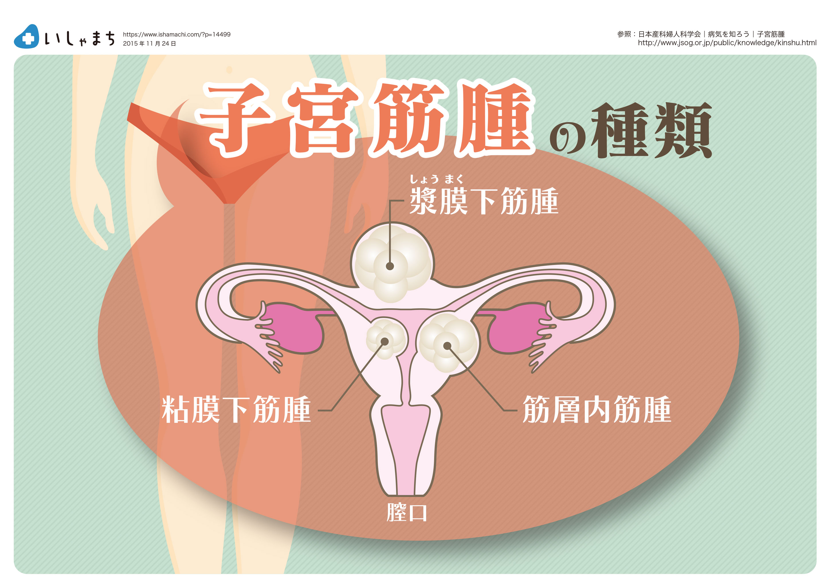 子宮筋腫の種類-図解