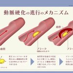 動脈硬化の進行のメカニズム