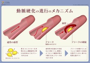 動脈硬化の進行のメカニズム