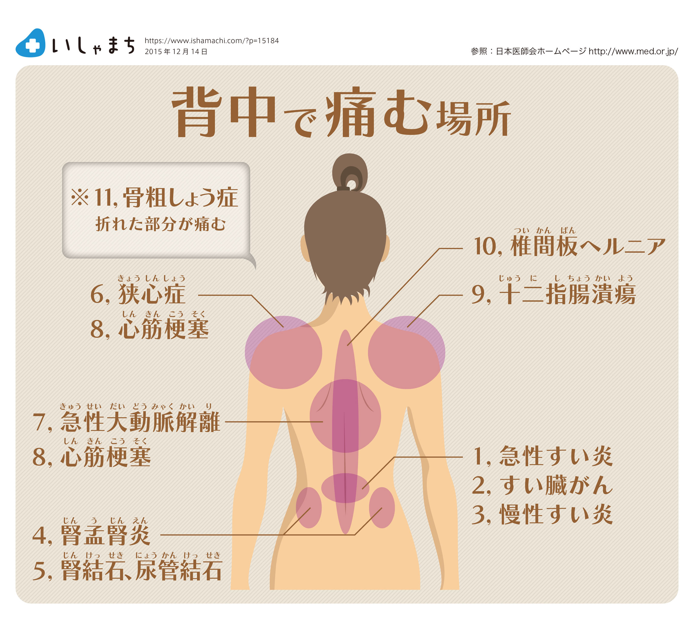 背中が痛む 痛む場所ごとに図で見る14の原因 肩こり それとも他の病気 いしゃまち