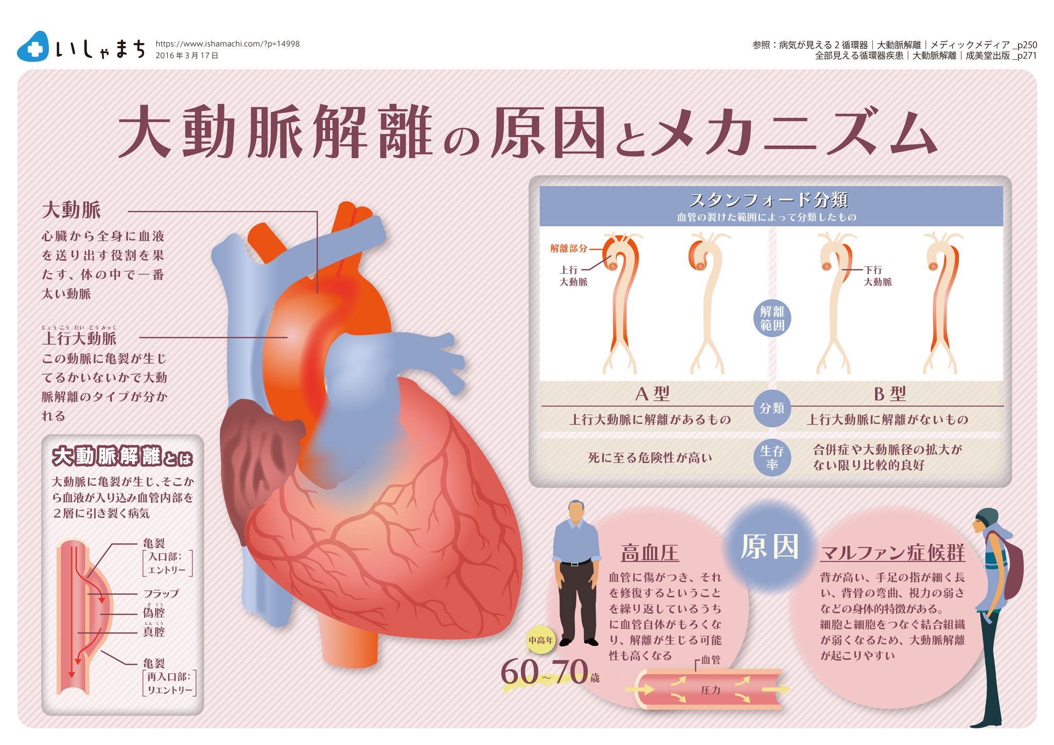 大動脈解離の原因とメカニズム-図解