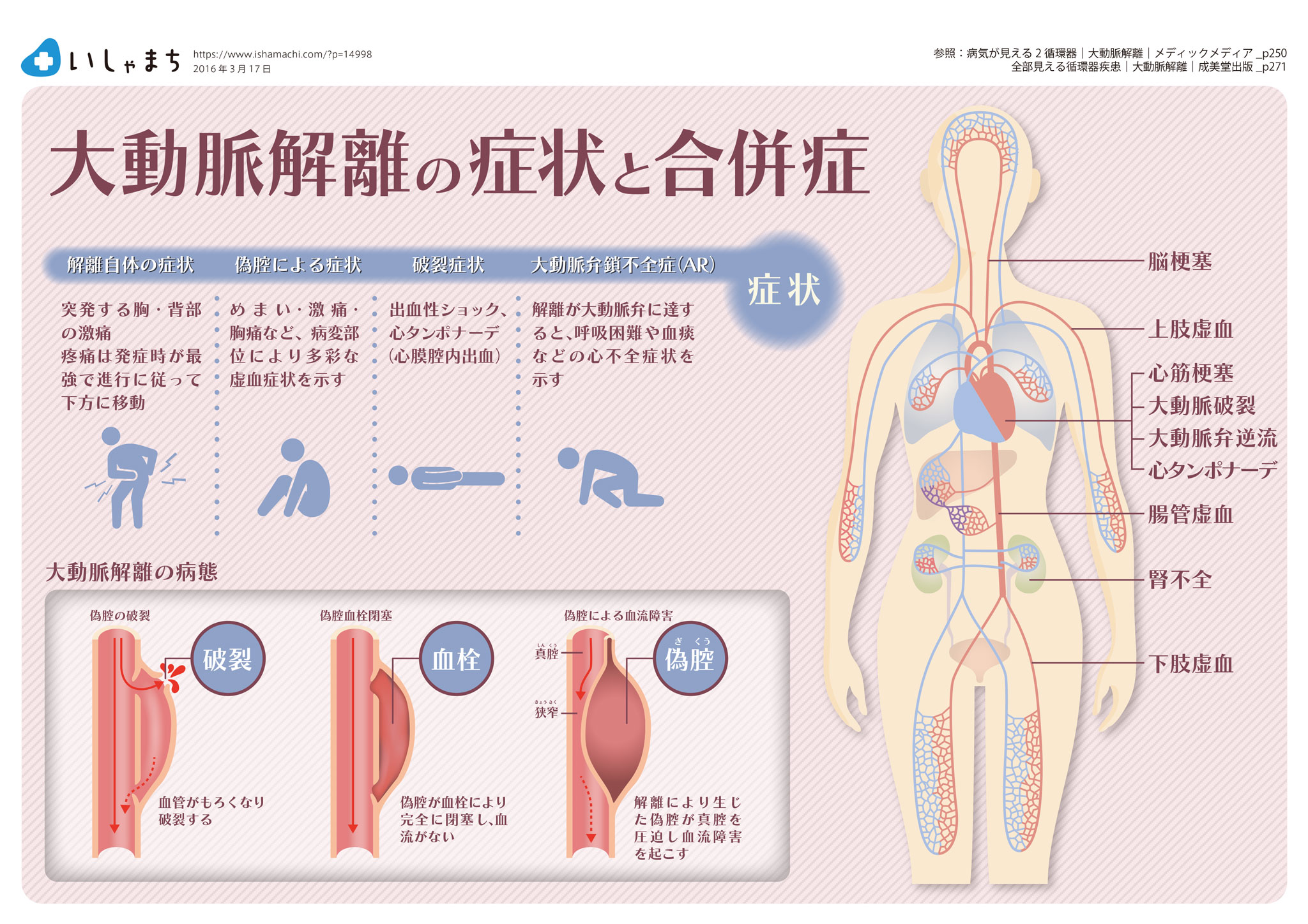 大動脈解離の症状と合併症-図解