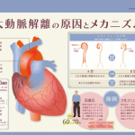 大動脈解離の原因とメカニズム