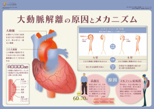 大動脈解離の原因とメカニズム