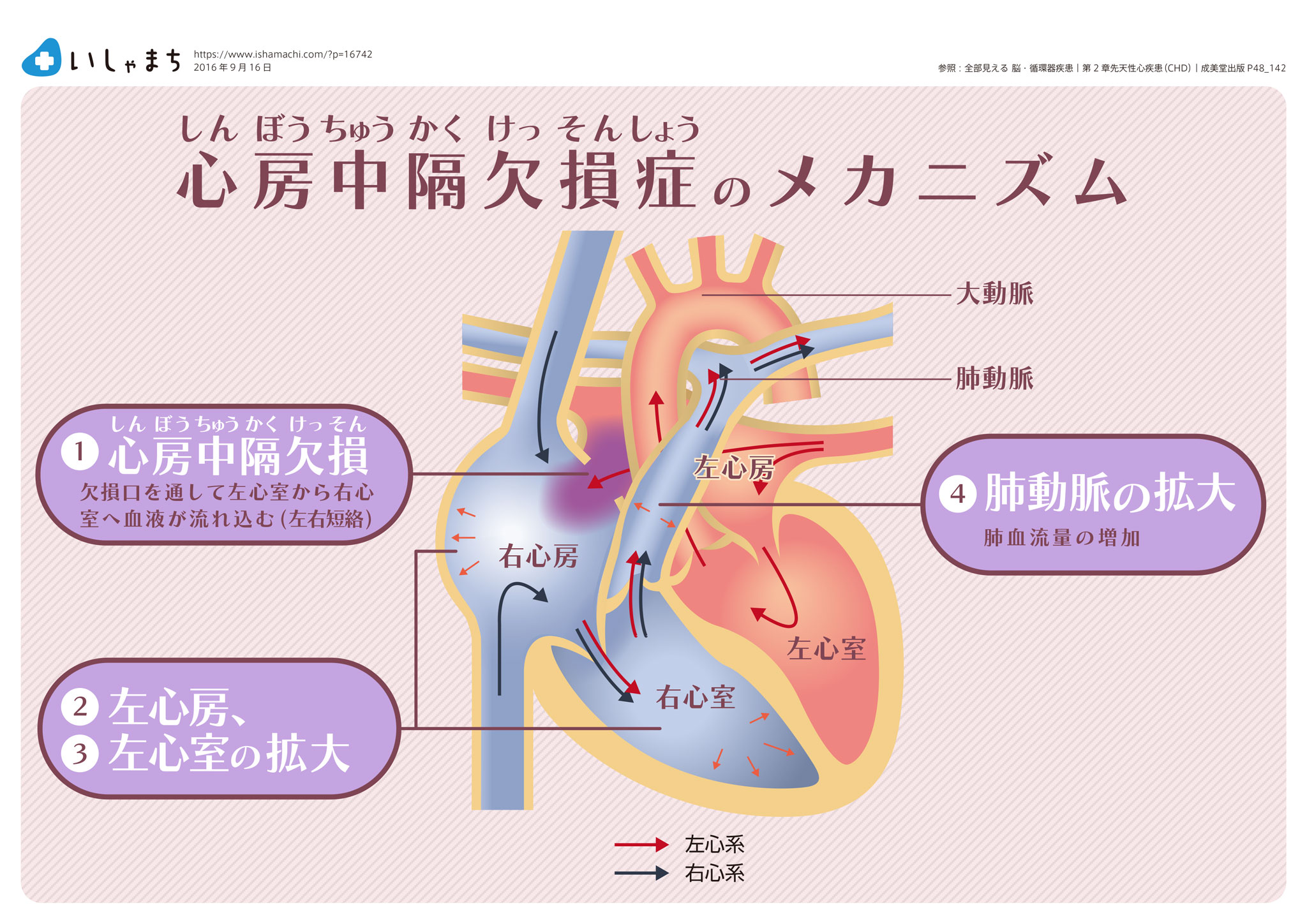 心房中隔欠損症のメカニズム-図解