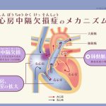 心房中隔欠損症のメカニズム