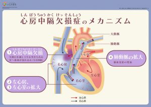 心房中隔欠損症のメカニズム