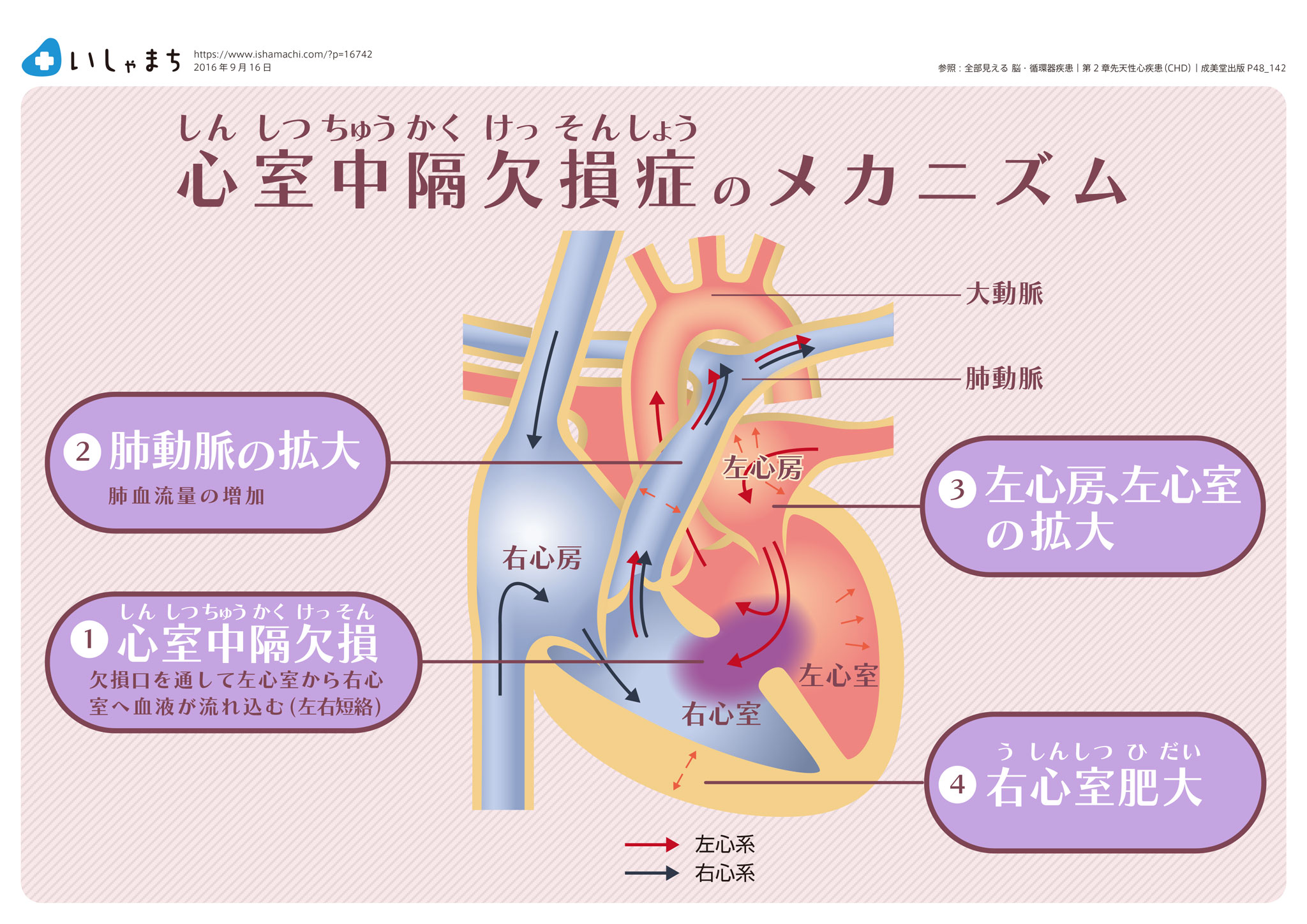 心室中隔欠損症のメカニズム-図解