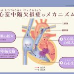 心室中隔欠損症のメカニズム