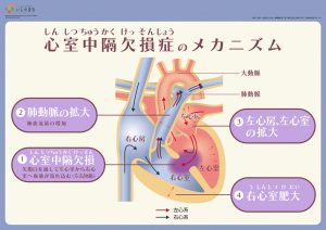 心室中隔欠損症のメカニズム