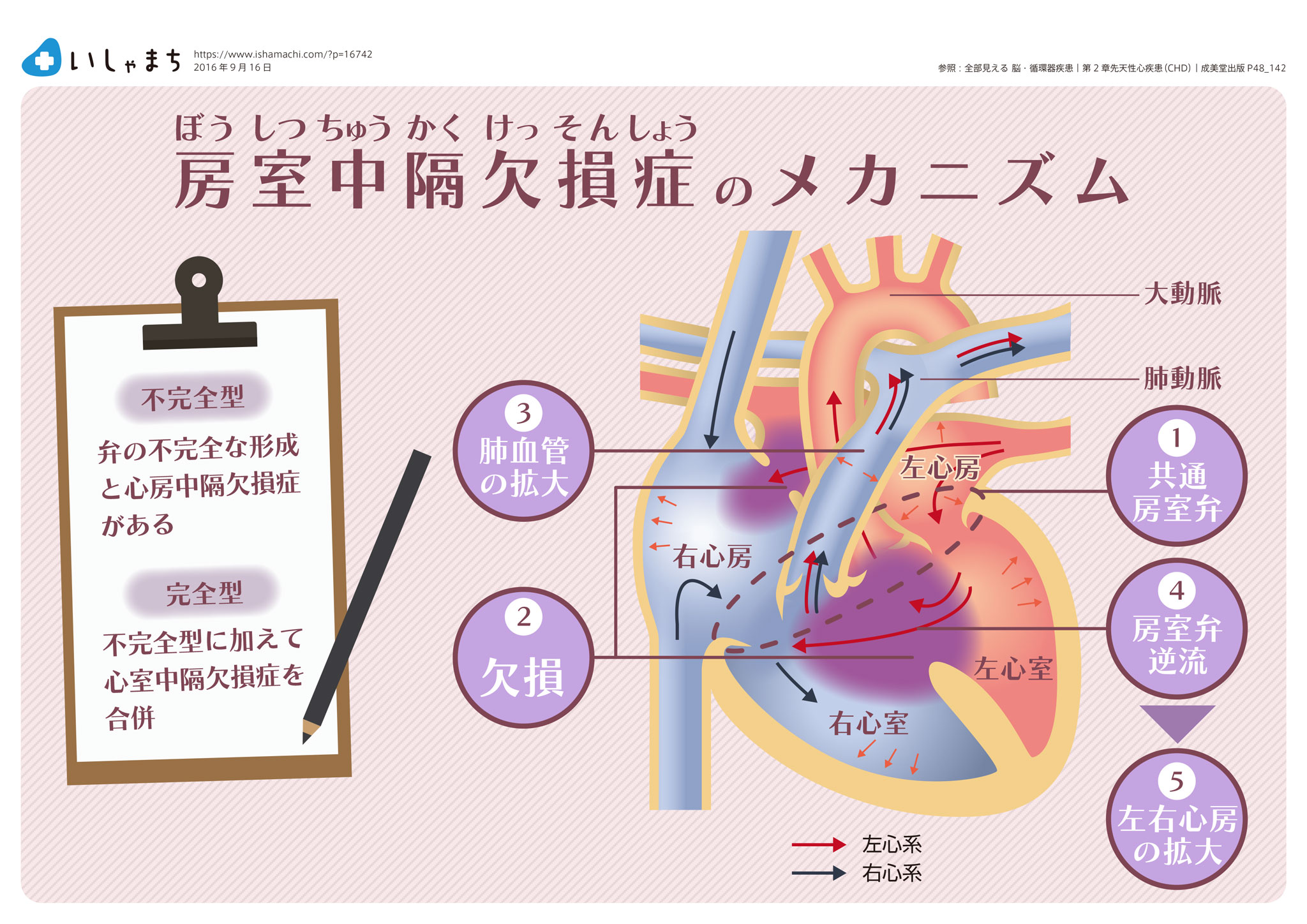 房室中隔欠損症のメカニズム-図解