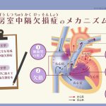 房室中隔欠損症のメカニズム