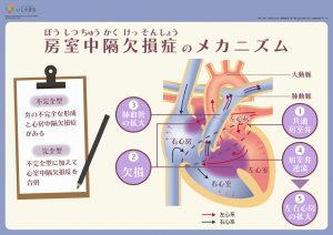 房室中隔欠損症のメカニズム