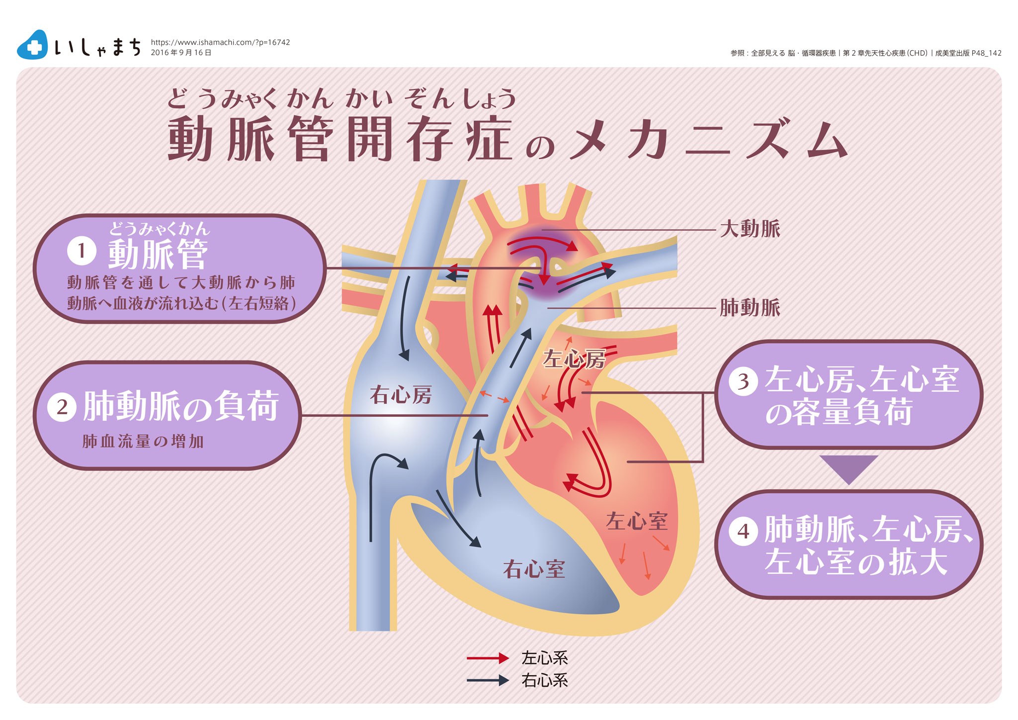 動脈開存症のメカニズム-図解