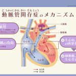 動脈開存症のメカニズム