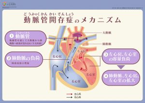 動脈開存症のメカニズム