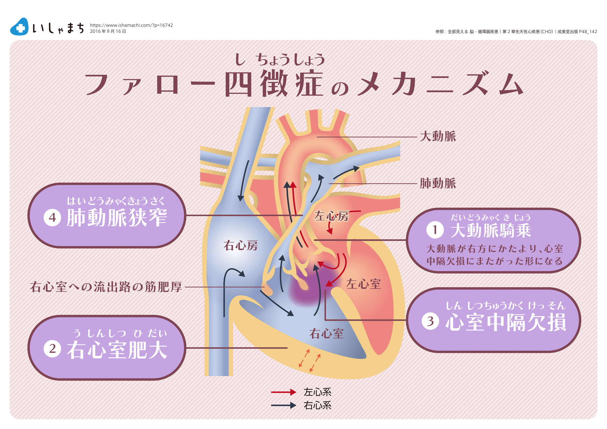 ファロー四徴症のメカニズム-図解