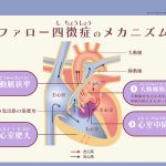 ファロー四徴症のメカニズム