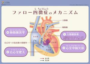 ファロー四徴症のメカニズム