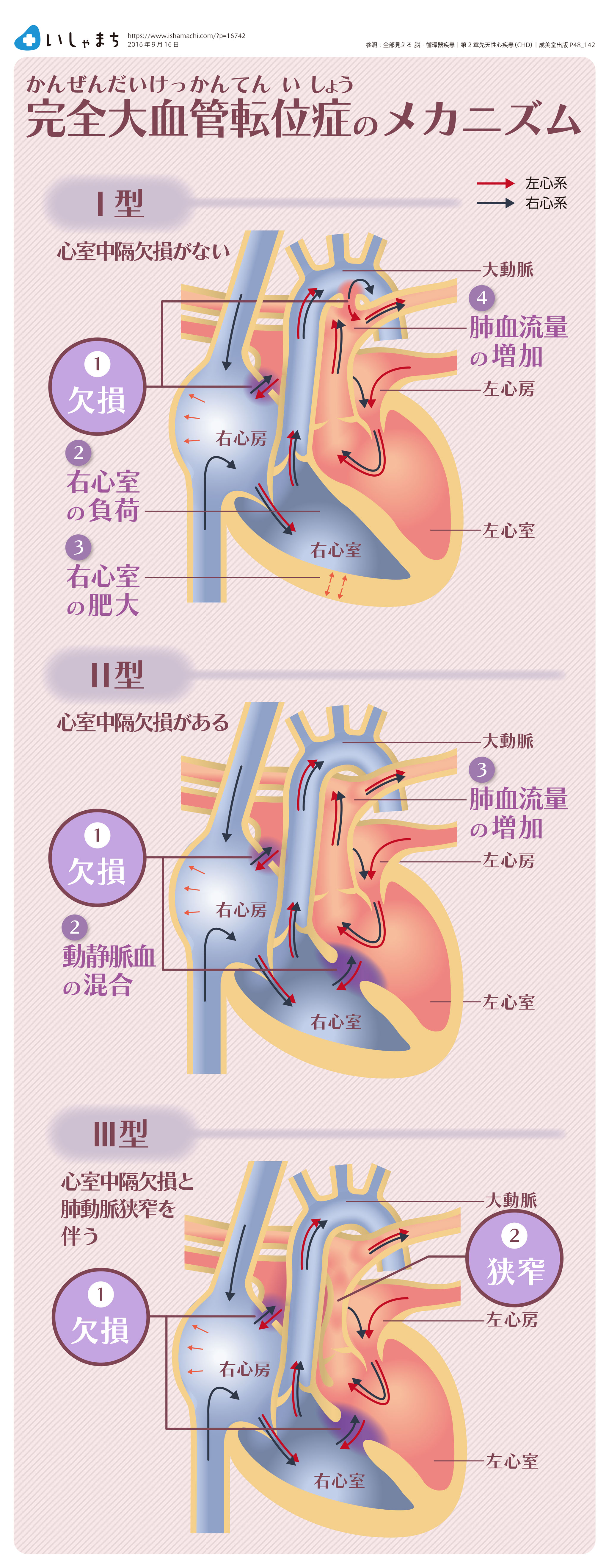 完全大血管転位症のメカニズム-図解