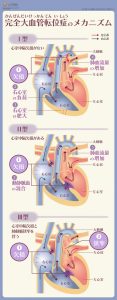 完全大血管転位症のメカニズム