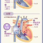 完全大血管転位症のメカニズム