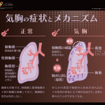 気胸の症状