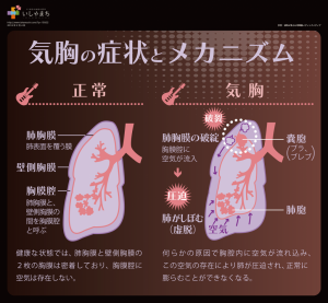 気胸の症状