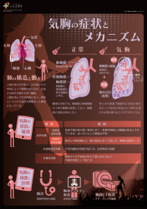 気胸の症状とメカニズム