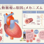 大動脈瘤の原因とメカニズム